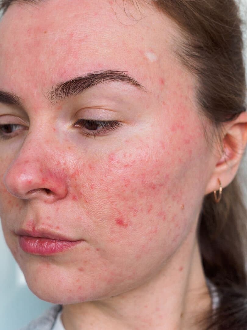 Rosacea symptoms