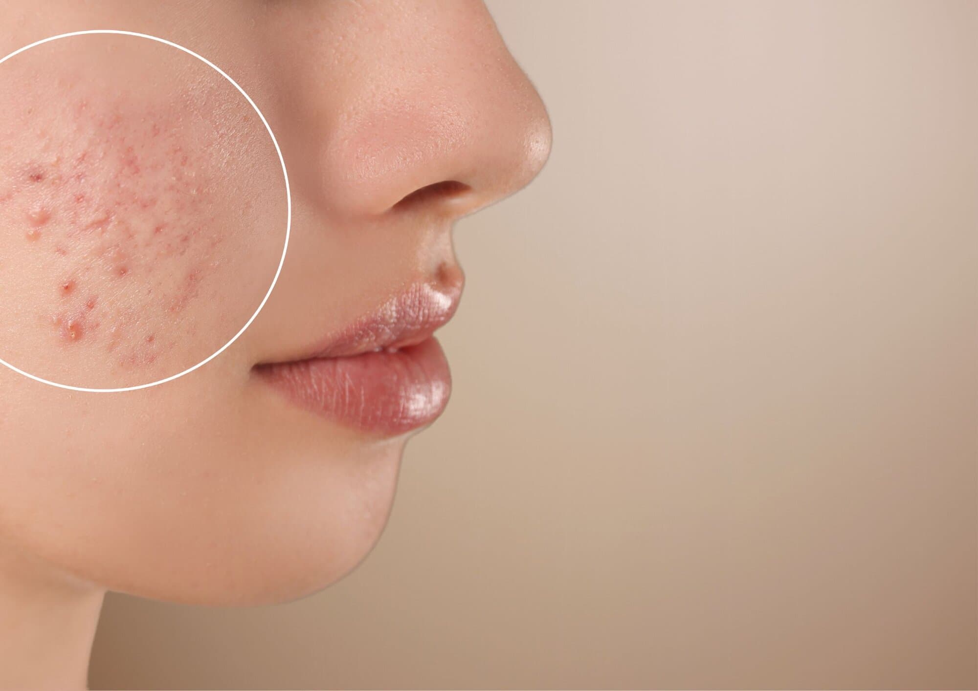 Aever Clinics - acne treatments