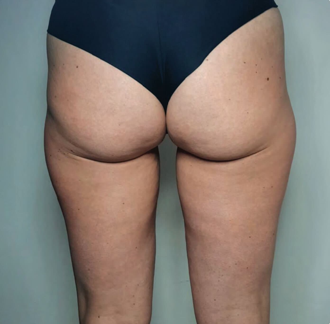 Body-toning-buttocks-after