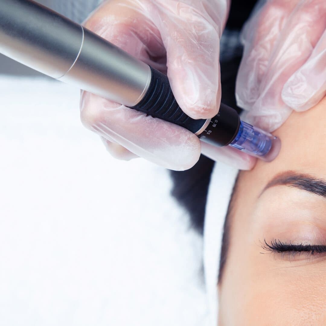 Microneedling boosts collagen production