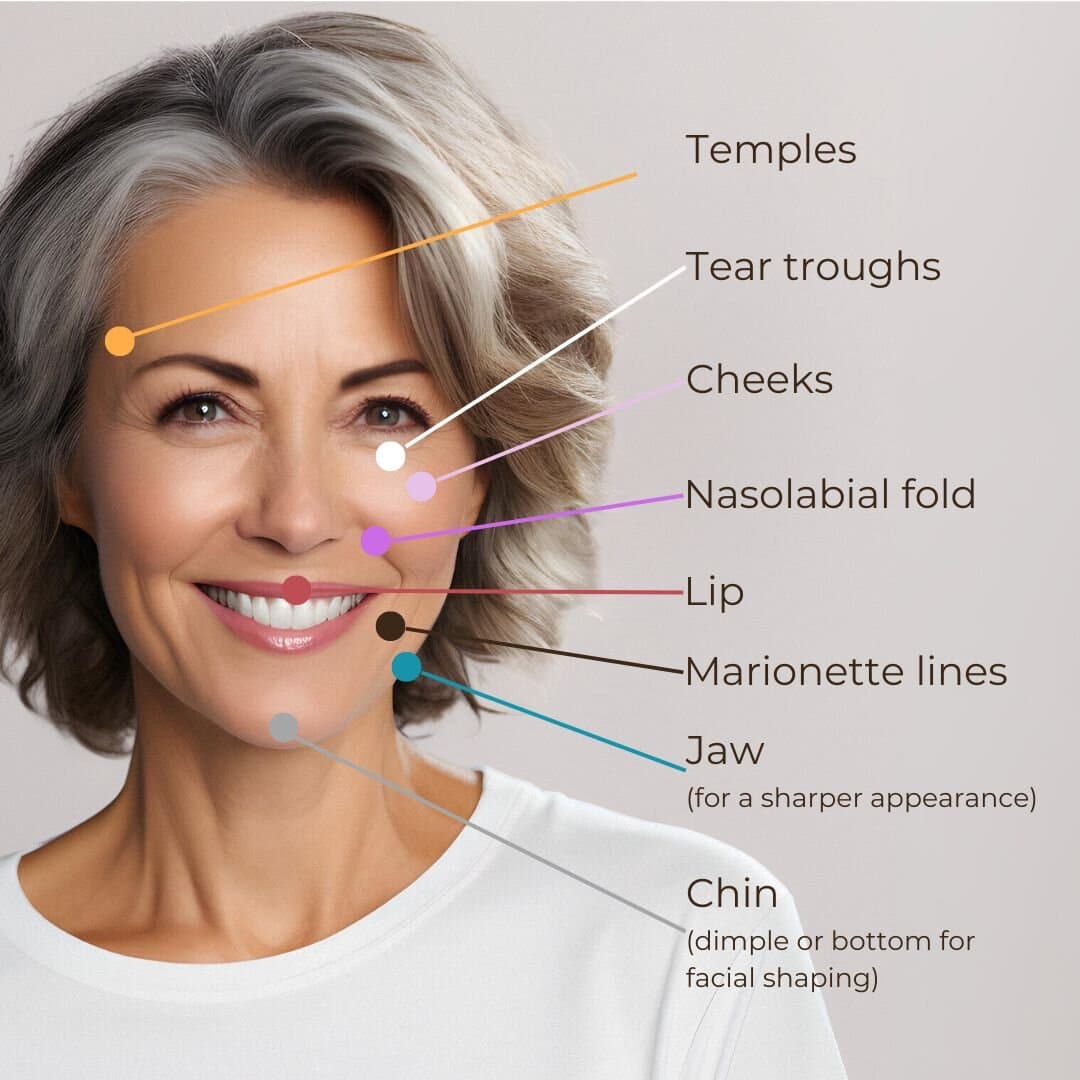 treatment areas of dermal filler