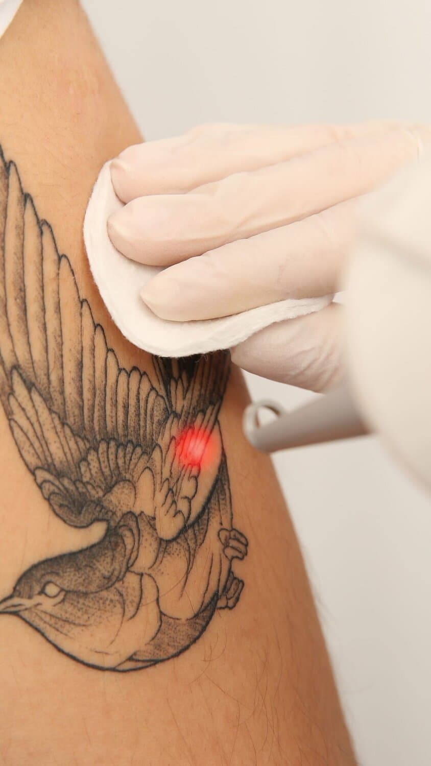 Tattoo Removal in Den Haag