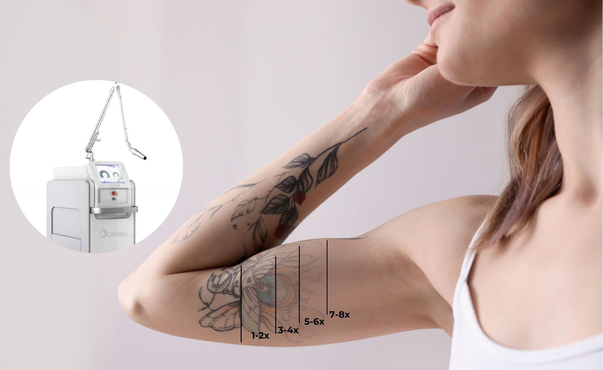 Aever Clinics - Tattoo Removal with the Candela PicoWay