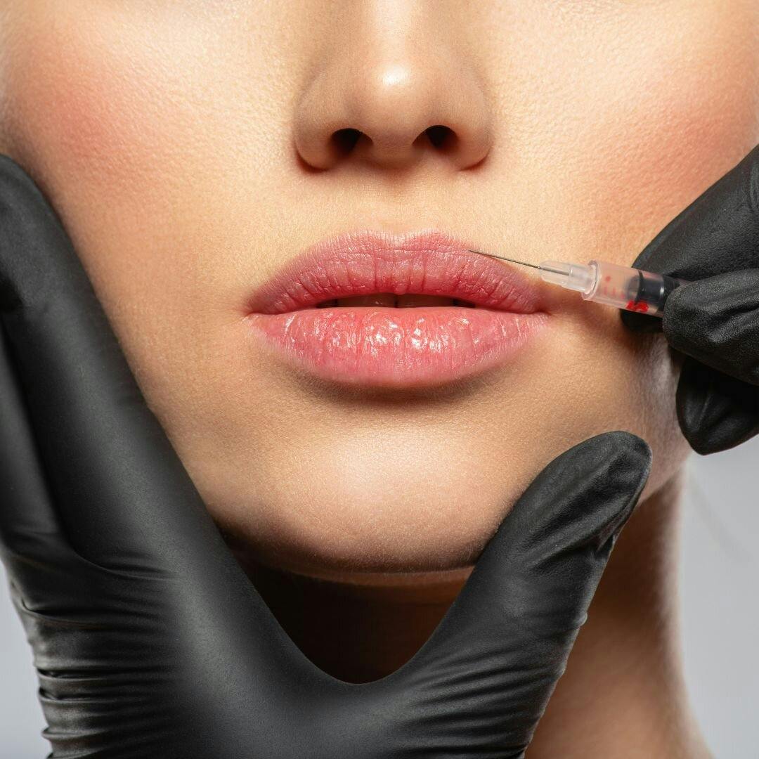 Lip Filler