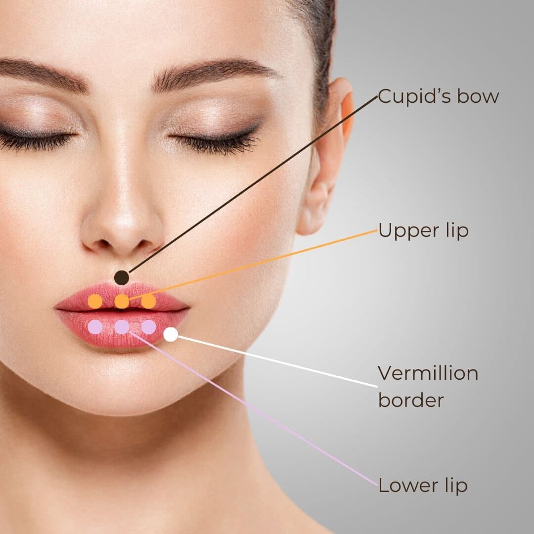 lip filler treatment areas