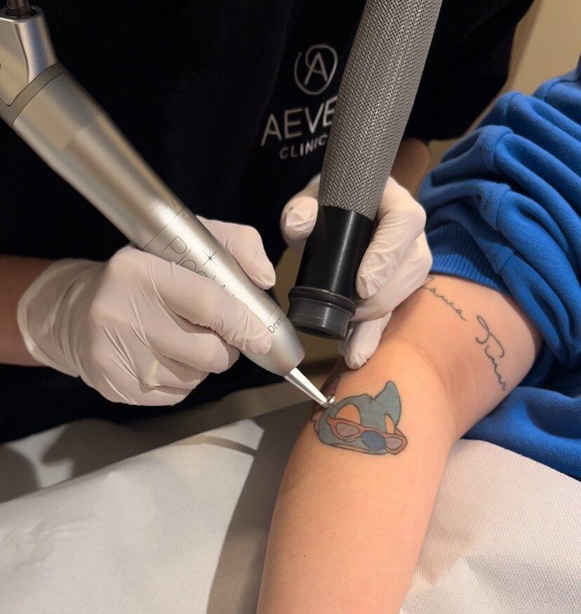 Tatoeage verwijderen bij Aever Clinics