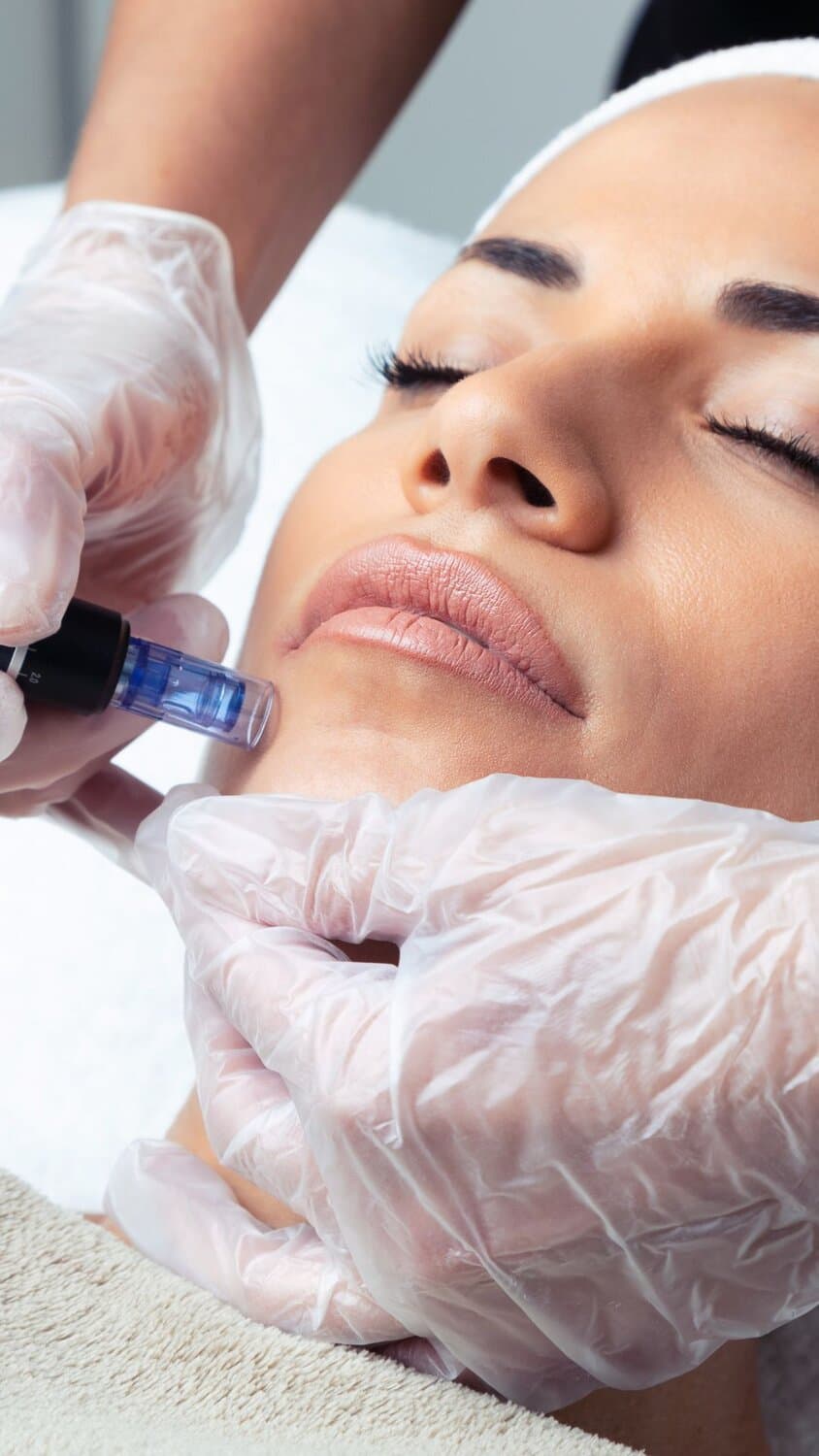 Microneedling Aever Clinics Utrecht