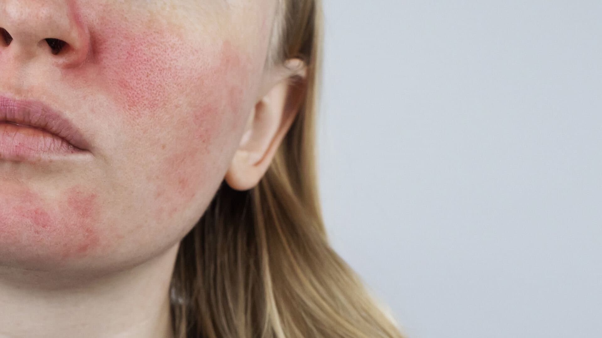 Aever Clinics - Rosacea