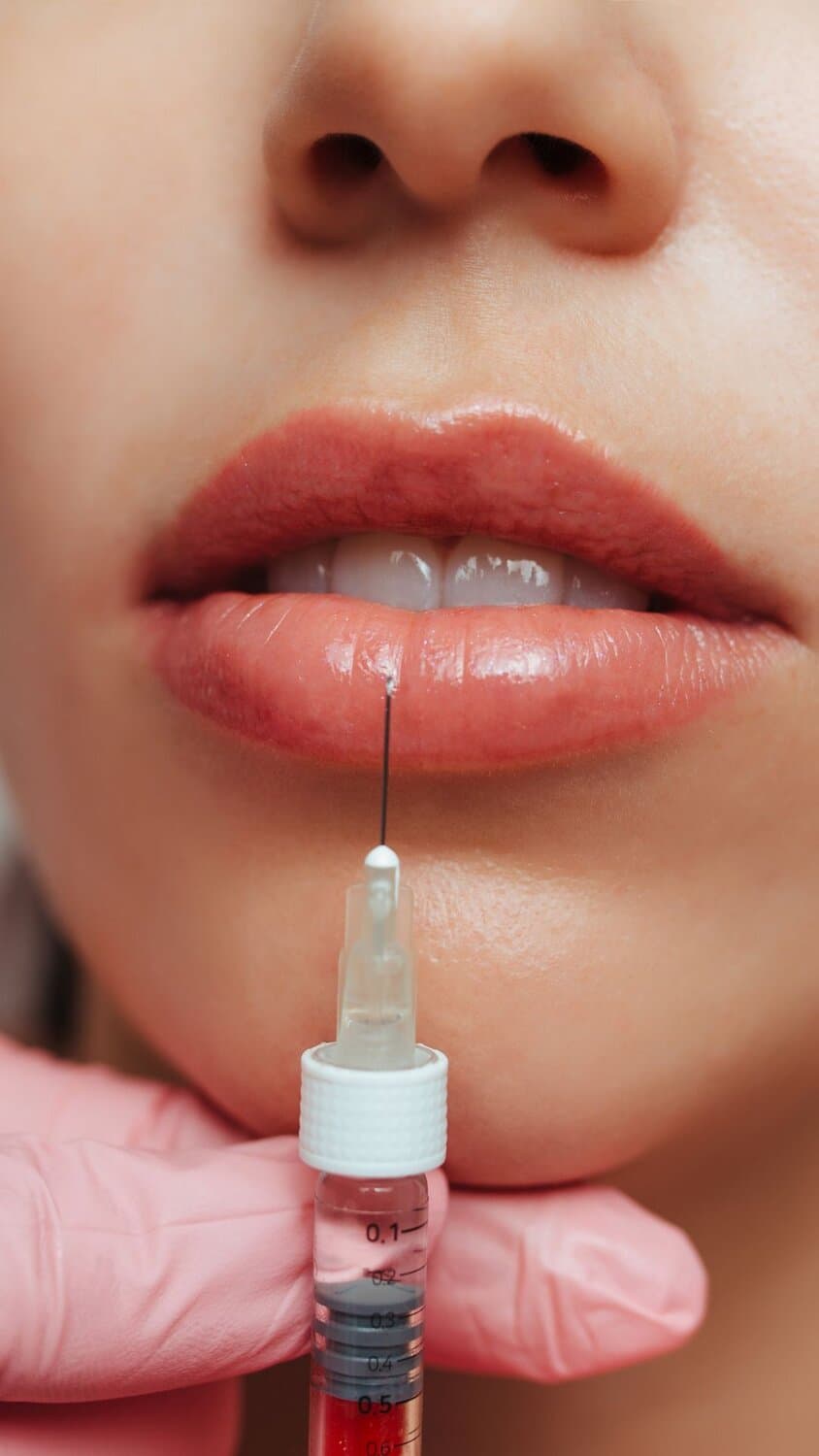 Lip Filler Aever Clinics Den Haag